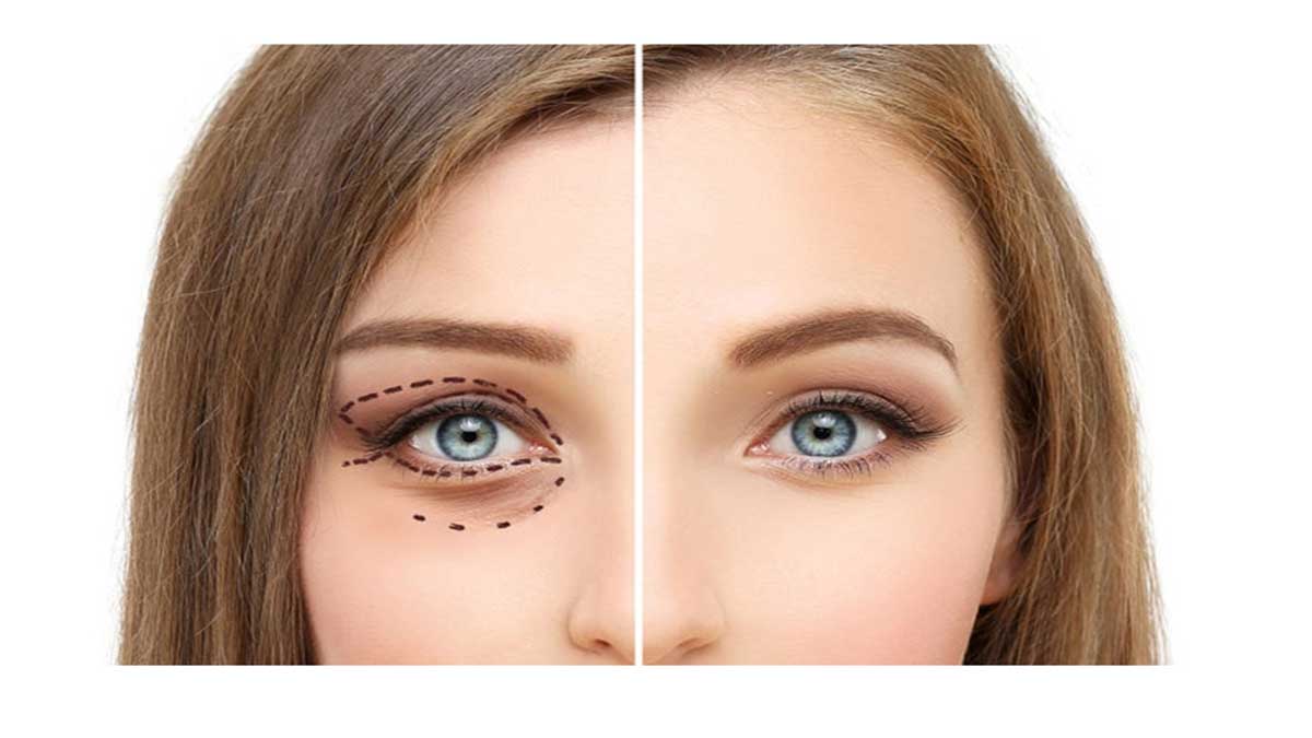 جراحی بینی طبیعی جراحی بینی طبیعی