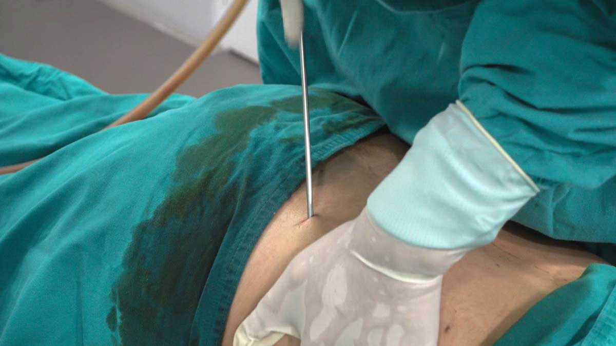 مرکز لیپوماتیک تهران عمل لیپوماتیک در تهران