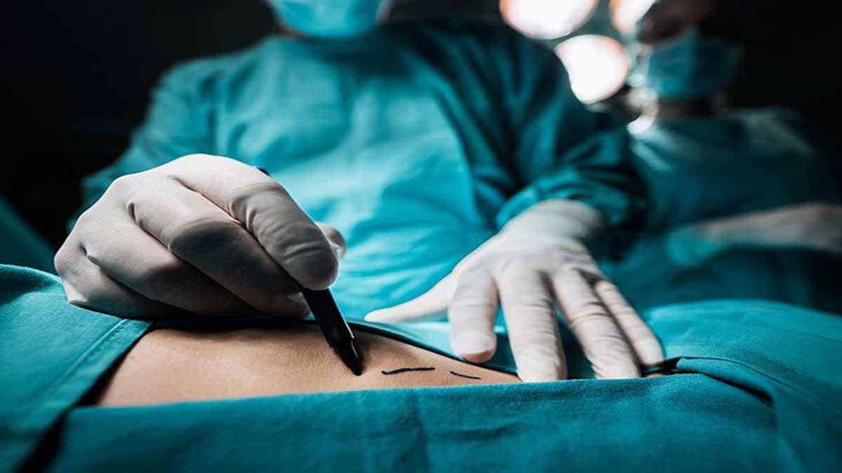 تغییرات بلندمدت لیپوساکشن تغییرات بلندمدت لیپوساکشن