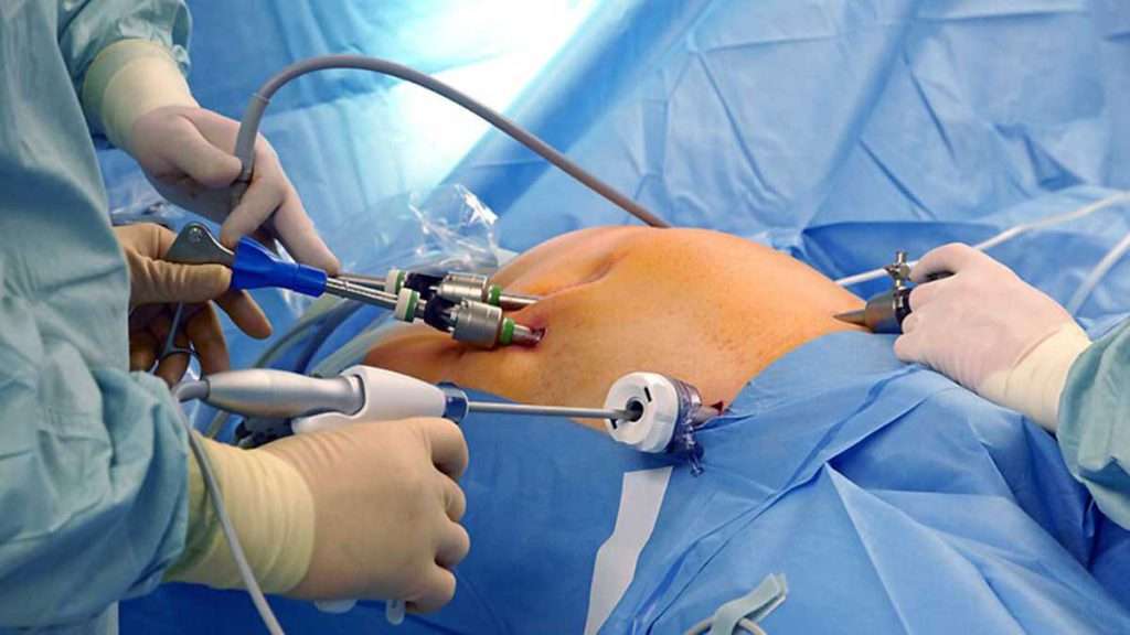 جراحی شکم و برداشتن چربی