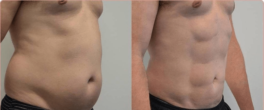 لیپوماتیک شکم پهلو