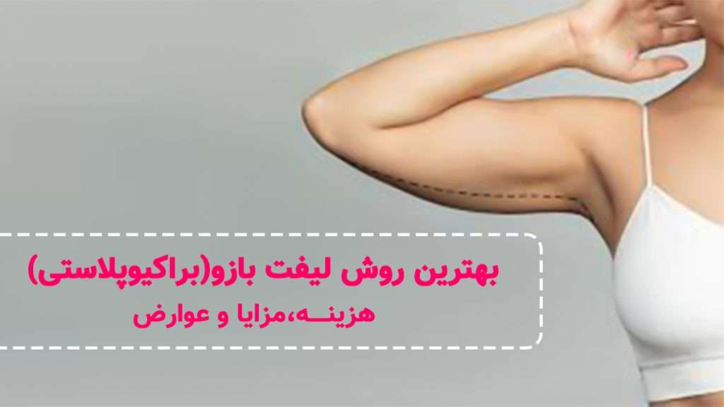 بهترین روش لیفت بازو (براکیوپلاستی)