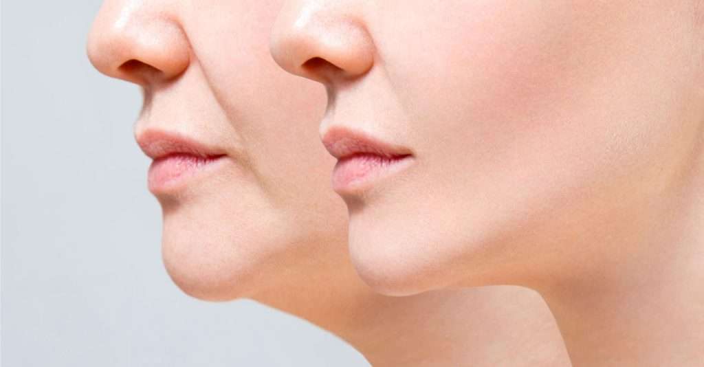 چربی اضافه غبغب غبغب