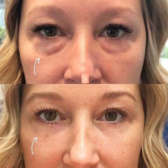 عکس تمام رخ چشم ها پس از بلفاروپلاستی