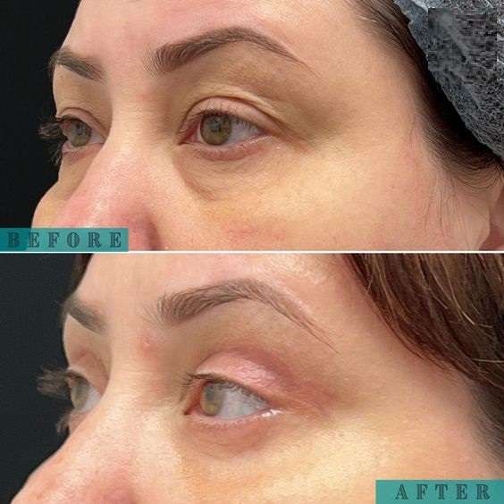 نمیا سه رخ چشم ها و پلک بعد از بلفاروپلاستی