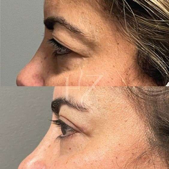 نیم رخ چشم ها بعد از لفاروپلاستی