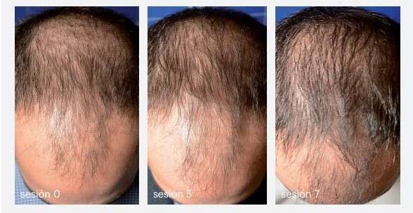 قبل و بعد مزو موی سر مرد