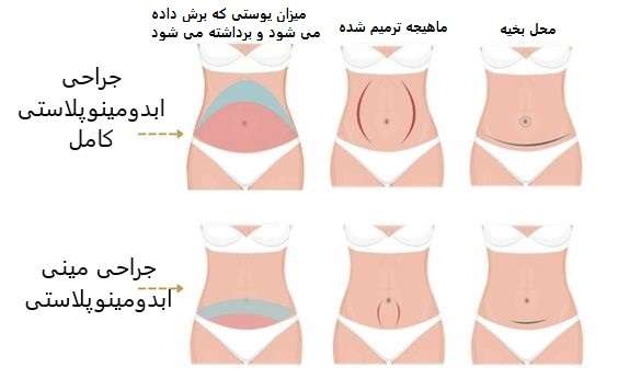 تفاوت ابدومینوپلاستی با مینی ابدومینوپلاستی