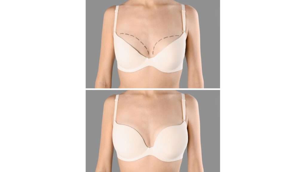 تغییر شکل سینه