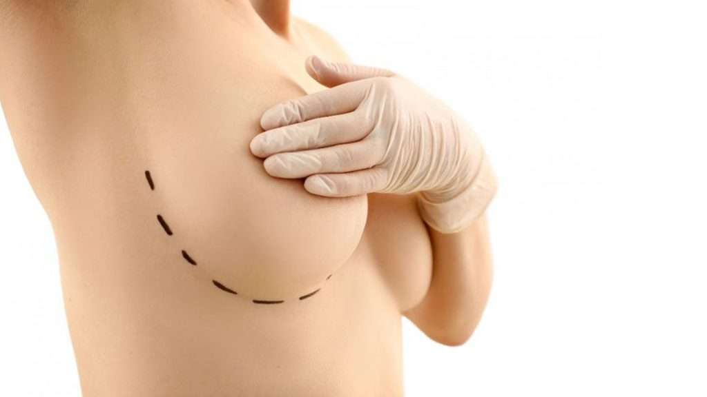 خط کشی ناحیه مجاز سینه جهت انجام لیفت خط کشی ناحیه سینه ها