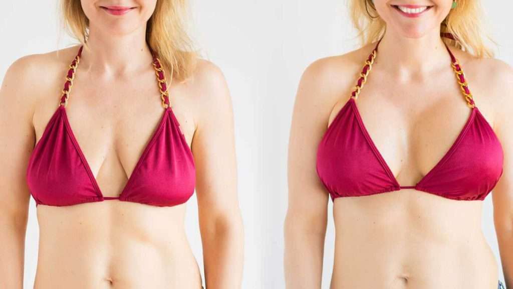 خوش فرم کردن و متقارن سازی سینه ها بدون جراحی. بالاکشیدن سینه ها