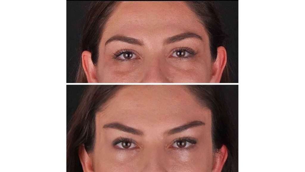 نوع لیفت شقیقه ترمیم جزئی