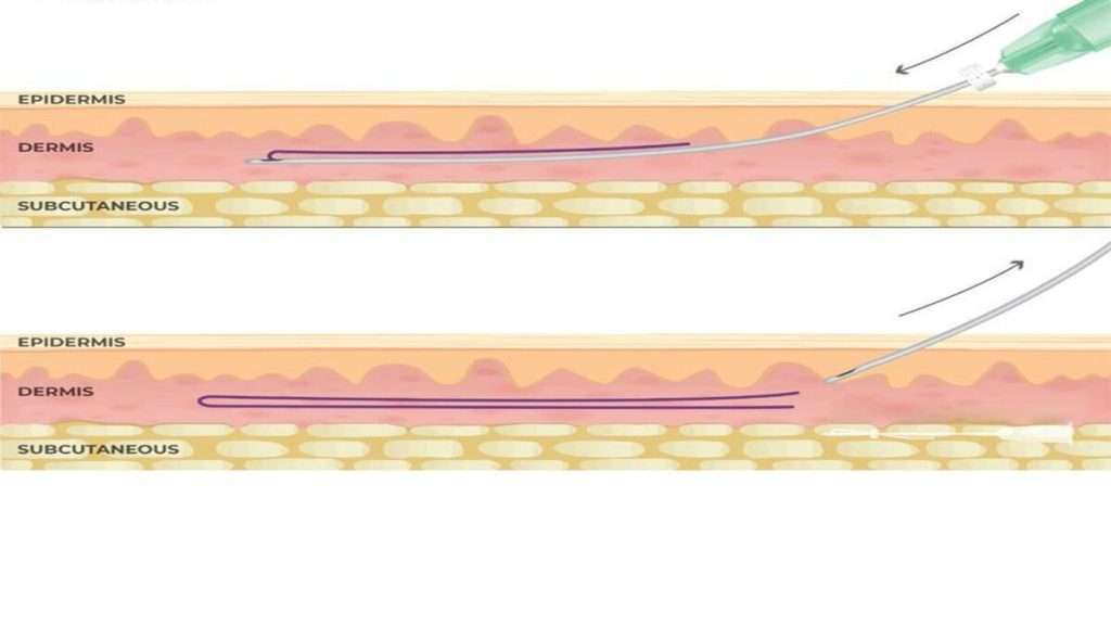 با امبدینگ چند کیلو لاغر می شویم نی نی سایت
