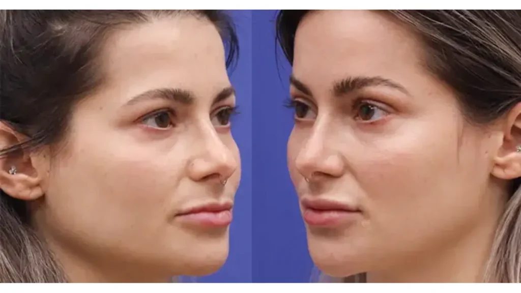 لیفت شقیقه ماندگاری لیفت شقیقه