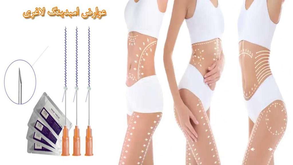 عوارص_امبذینگ