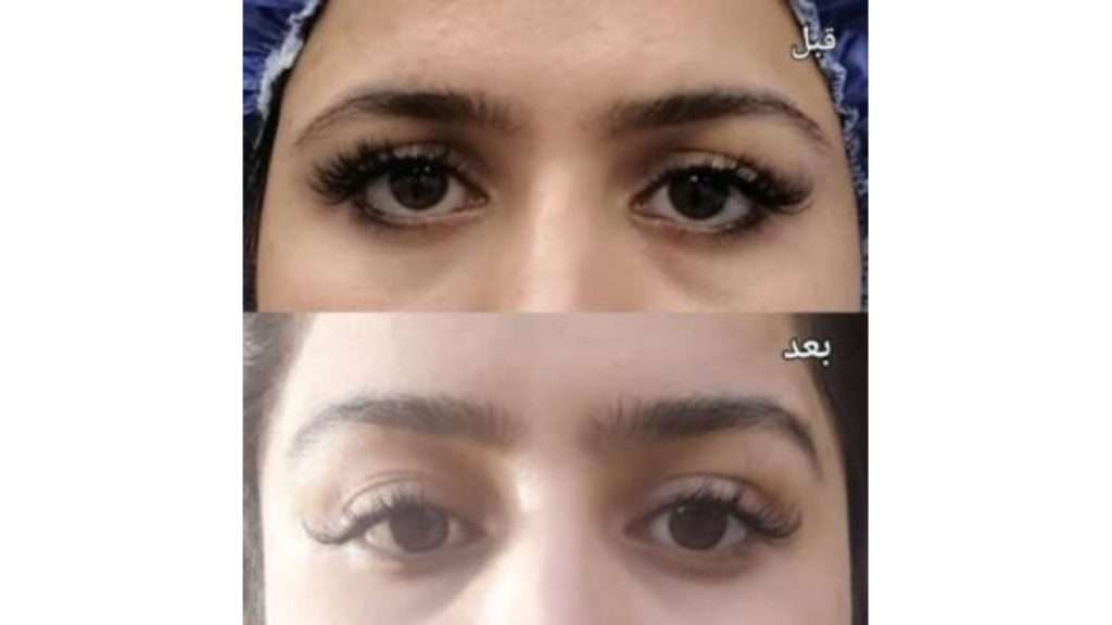 استفاده از بخیه مراقبت های بعد از لیفت شقیقه غیرجراحی