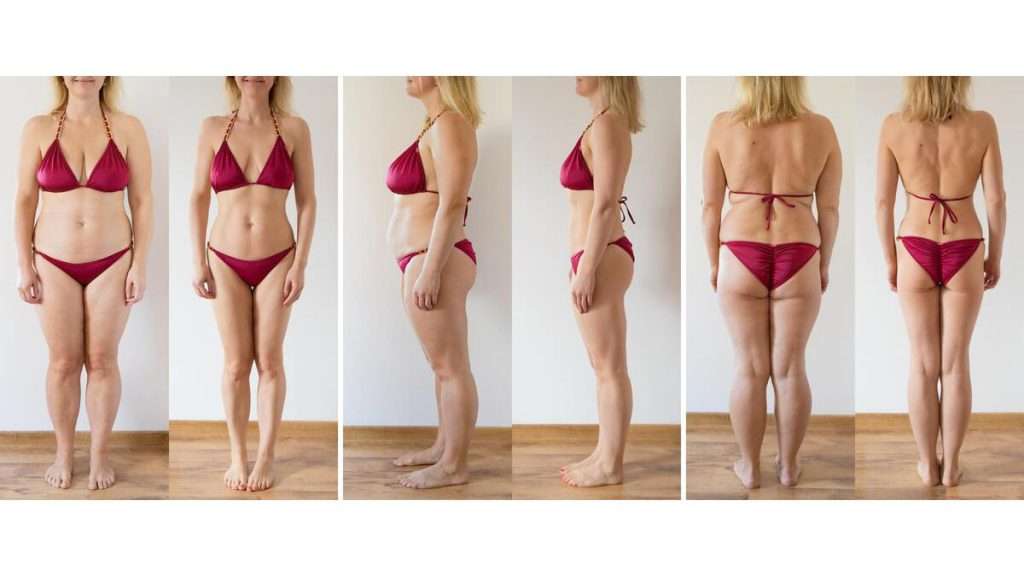 کرایولیپولیزیس اولتراسوند