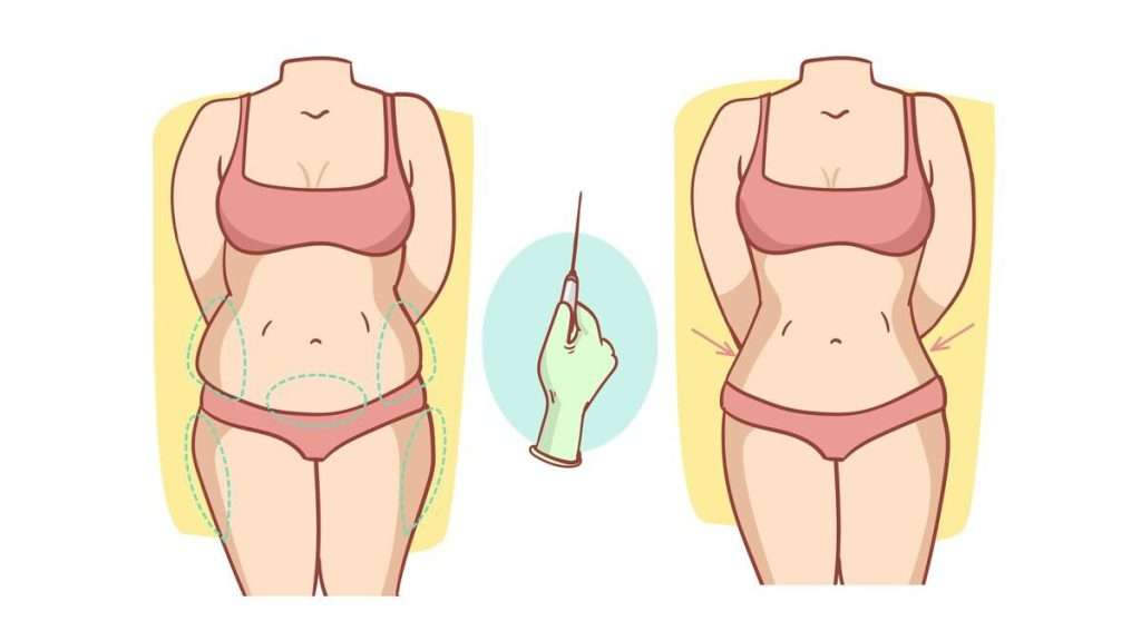 تاثیر_امبدینگ_برلاغری_هزینه_هر جلسه_امبدینگ