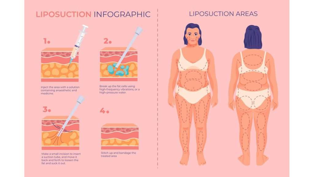 لیپوساکشن ویزر بهترین روش لیپوساکشن