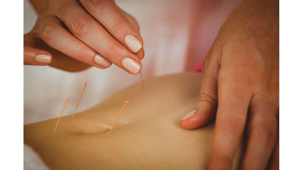 تحریک نقاط طب سوزنی