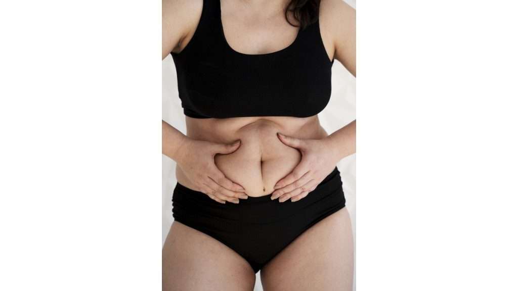 چاقی مفرط عمل لیپوساکشن