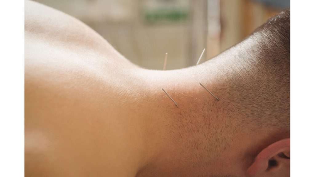  طب سوزنی گوش برای لاغری
