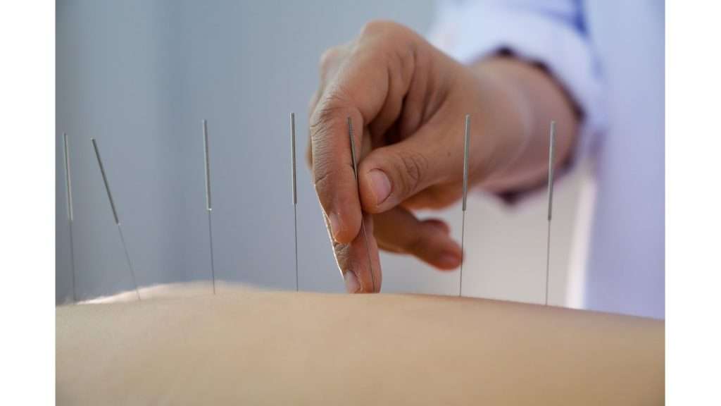 مراحل انجام طب سوزنی انتخاب نقاط طب سوزنی