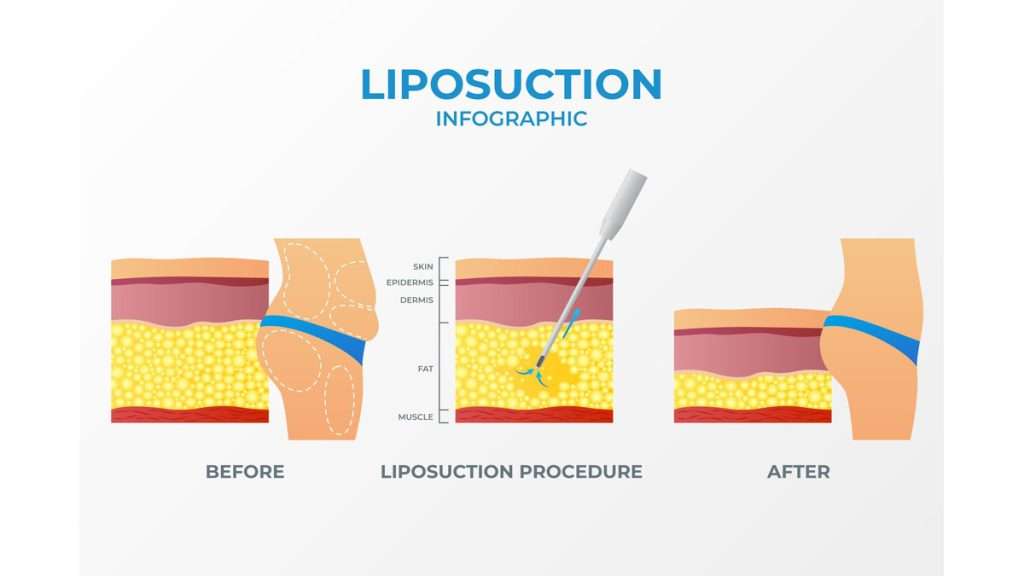 لیپوساکشن سنتی لخته شدن خون