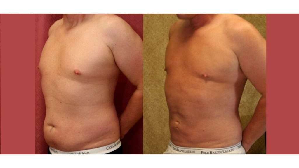 هزینه لیپوساکشن میزان چربی که باید از بین برود: