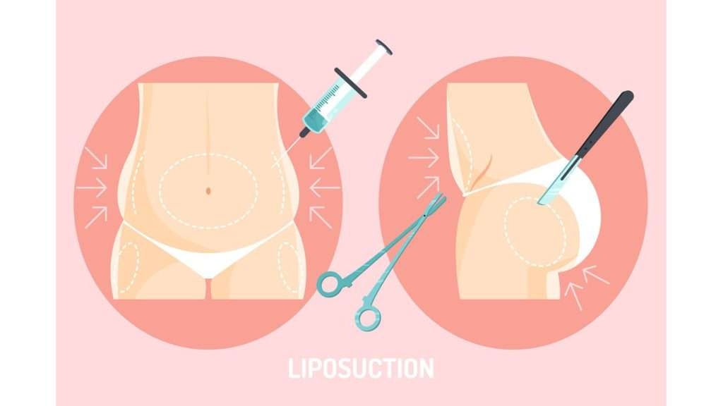 هزینه لیپوساکشن
