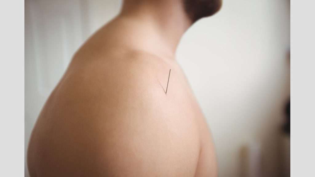 جلسات طب سوزنی