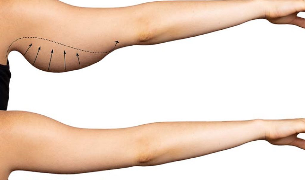 براکیوپلاستی چیست؟براکیوپلاستی عمل حذف پوست وچربی اضافه برای بهبود شکل بازوهاست