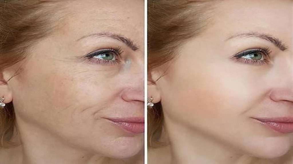 هایفو باعث رفع چین و روک میشود