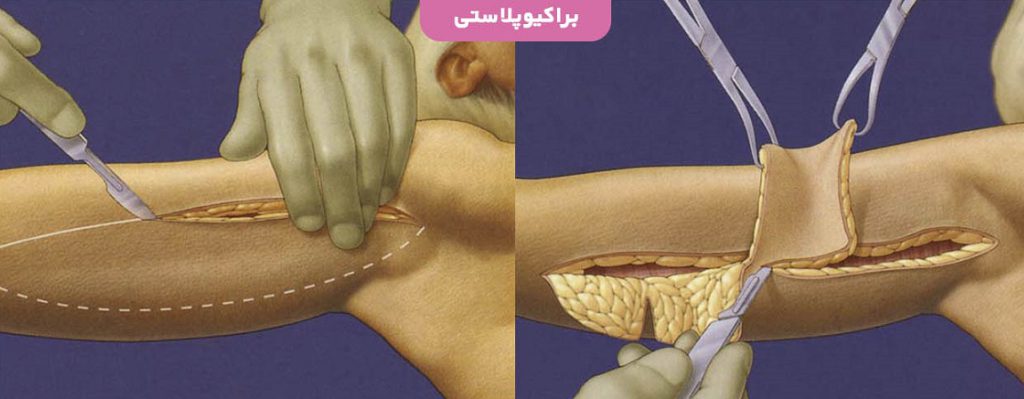 برای جراحی برایکوپلاستی یک برش درقسمت زیرین بازو داده می شود وچربی ها وپوست اضافی خارج می شود