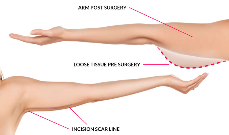 رعایت برخی نکات مثل استعلام قیمت جراحان مختلف ،استفاده از بیمارستان های دولتی،خارج از فصل عمل کردن و...باعث کاهش هزینه های عمل می شود
