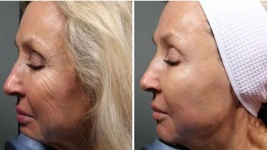 ماندگاری نتایج هایفوتراپی هایفو باعث جوانسازی پوست میشود