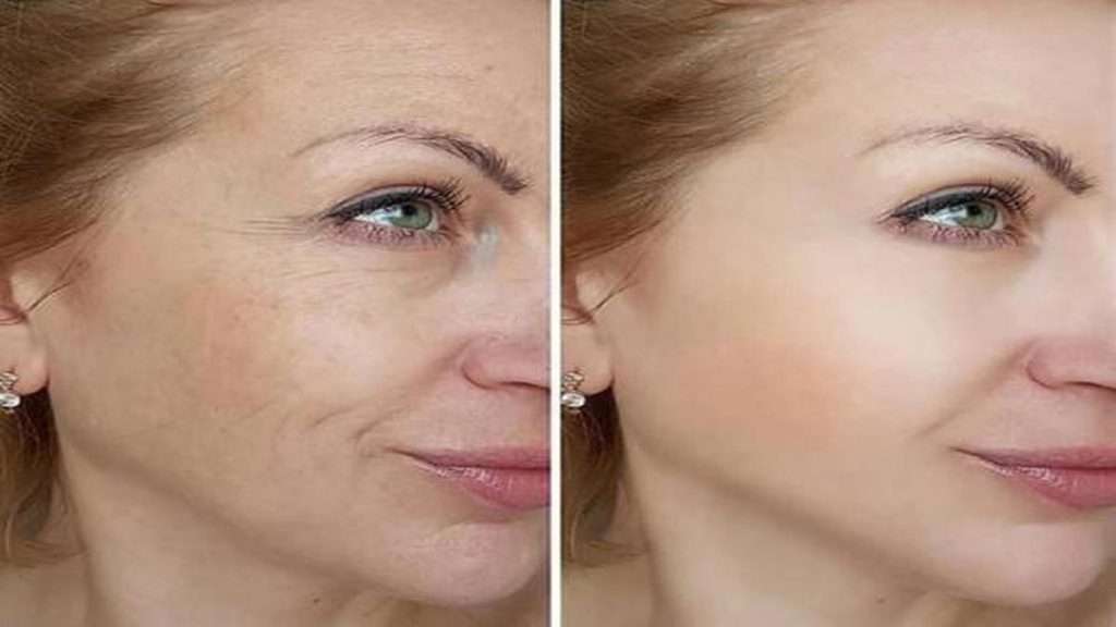 هزینه هایفوتراپی هایفو برای خط خنده