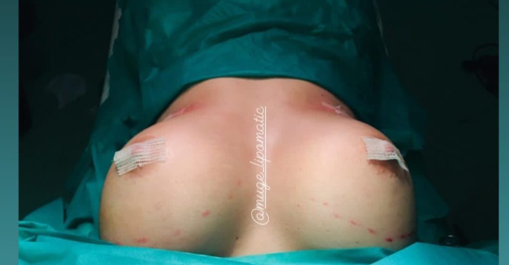 نمونه عمل مامو پلاستی سینه هایی که عمل مامو پلاستی روش انجام شده است