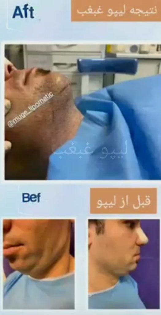 نمونه عمل لیپو غبغب اقایی قبل وبعد از جراحی غبغب