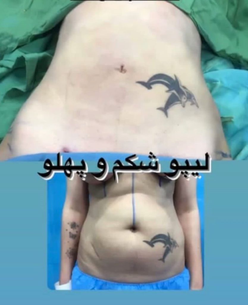نمونه عمل قبل وبعد ابدومینو پلاستی شکم قبل وبعد از عمل ابدومینوپلاستی