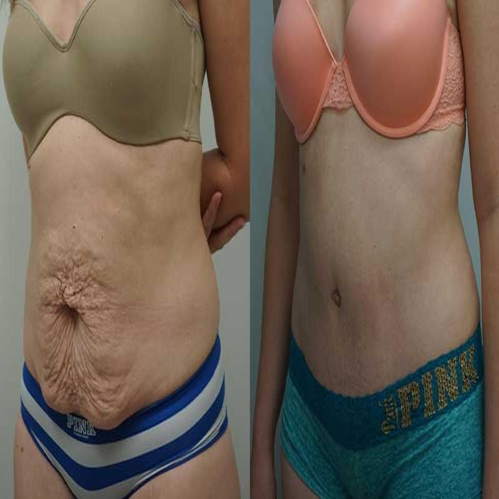 نظارت مراقبت پزشکی قبل و بعد ابدومینوپلاستی