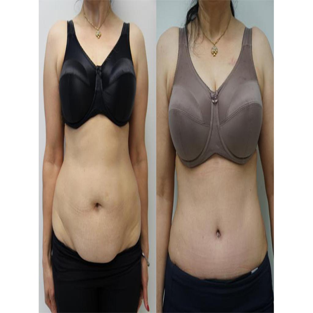 عمل جراحی بخیههای جذبی