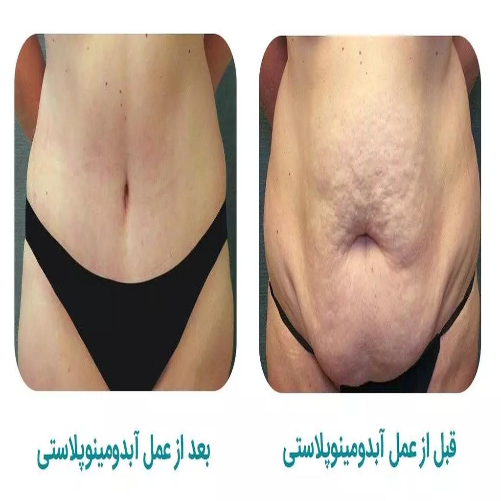 جراحی ابدومینوپلاستی ابدومینوپلاستی یا تامی تاک