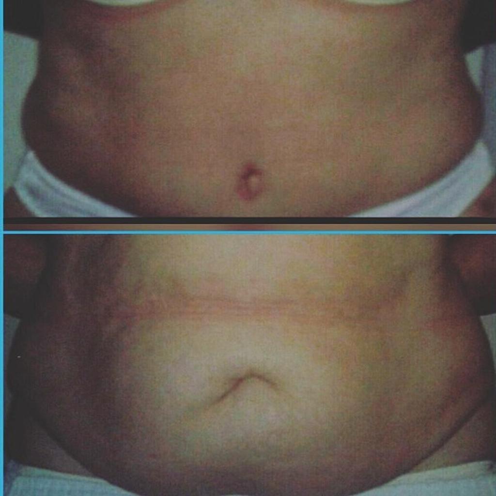 کاهش اندام شکمی عمل آبدو