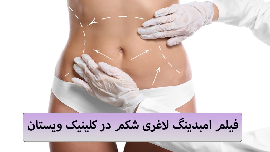 امبدینگ شکم یک پزشک که با دست شکم یک شخص را برای عمل امبدینگ اندازه گیری می کند و یک نوشته با عنوان فیلم امبدینگ شکم