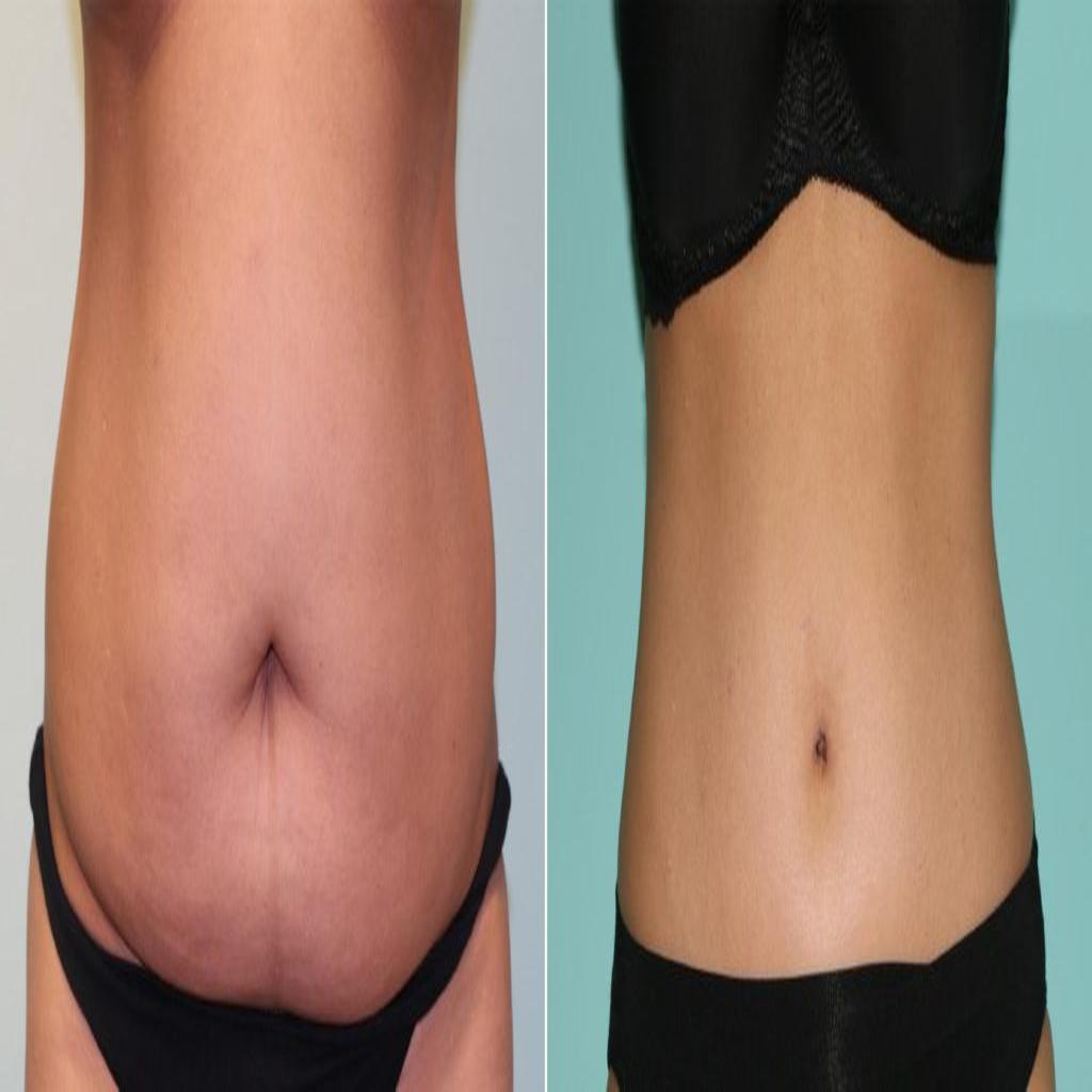 چربیهای اضافی افزایش و کاهش حجم