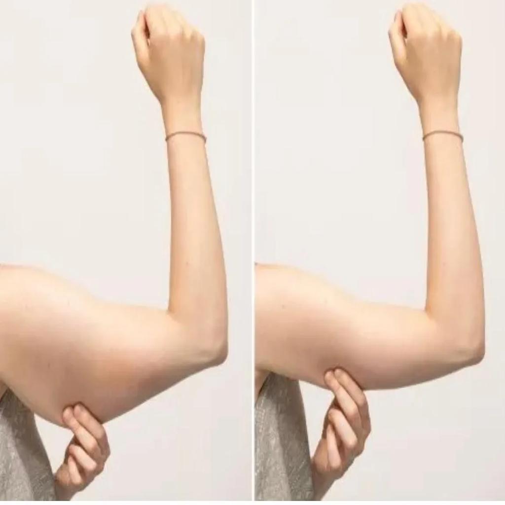 افزایش حجم بازو لیزر لیپوئیشن بازو