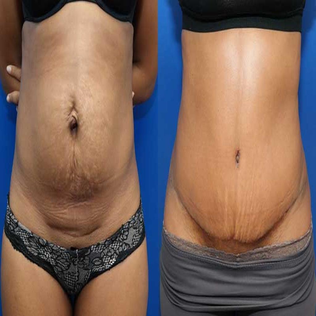 کاهش چربیهای اضافی بهبود شکل و ظاهر شکم