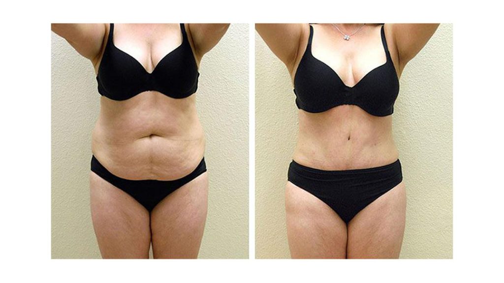 نتایج نهایی ابدومینوپلاستی