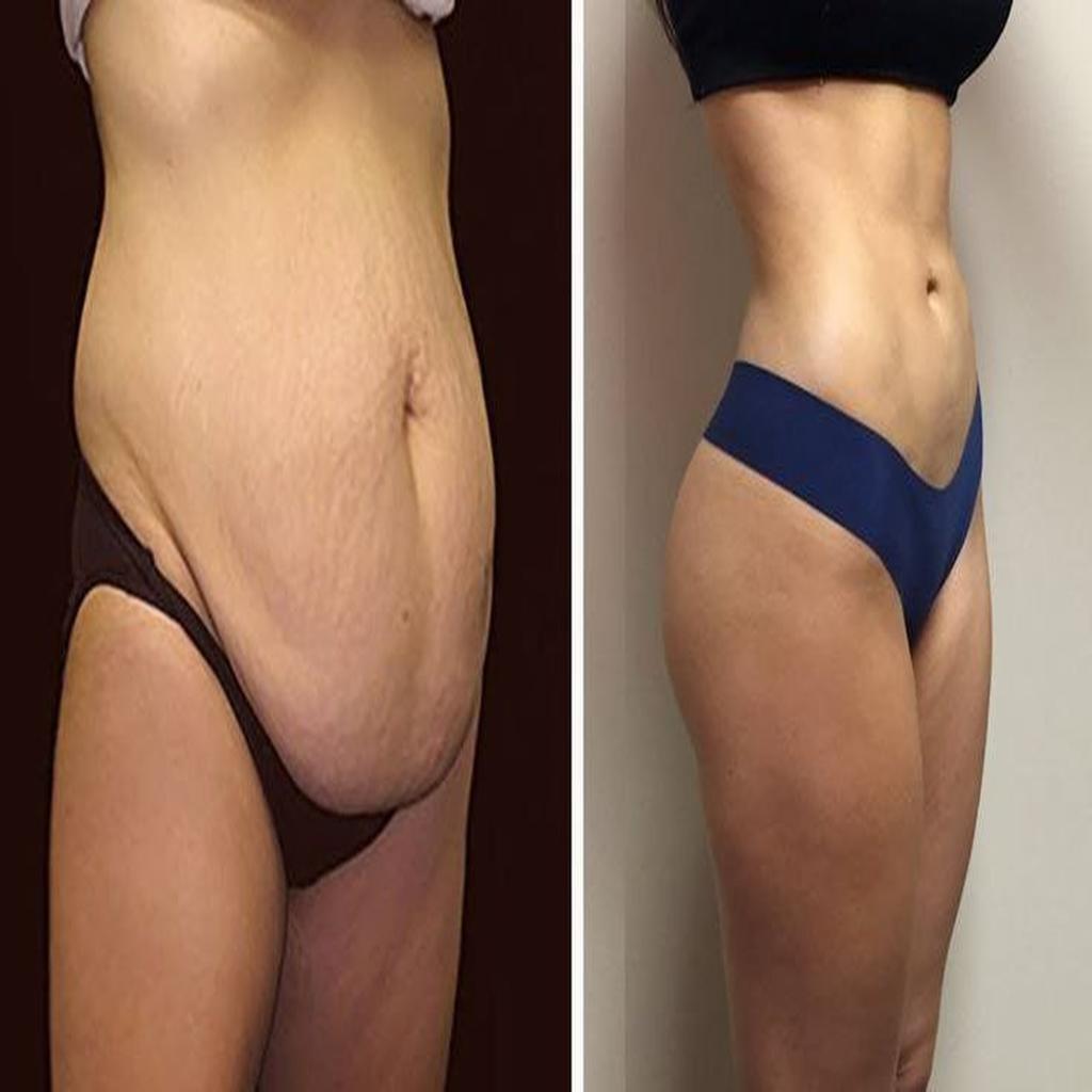 امبولی تشکیل لختههای خونی